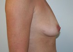 Breast Augmentation