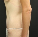 Tummy Tuck (Abdominoplasty)