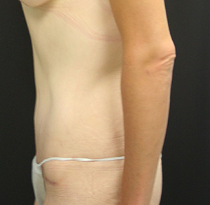 Tummy Tuck (Abdominoplasty)