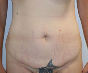 Tummy Tuck (Abdominoplasty)