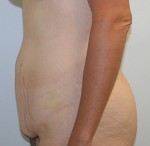 Tummy Tuck (Abdominoplasty)