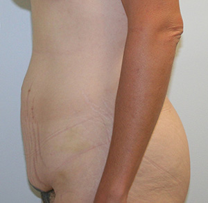 Tummy Tuck (Abdominoplasty)