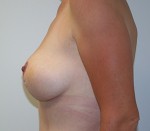 Breast Lift (Mastopexy)