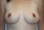 Breast Lift (Mastopexy)