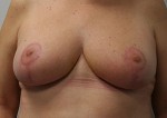 Breast Reduction (Reduction Mammaplasty)