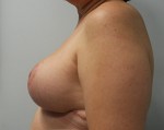Breast Reduction (Reduction Mammaplasty)