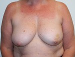 Breast Reconstruction after Mastectomy