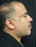Face Lift