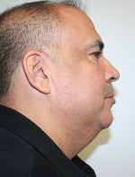 Face Lift