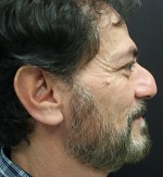 Nose Surgery (Rhinoplasty)