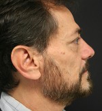 Nose Surgery (Rhinoplasty)