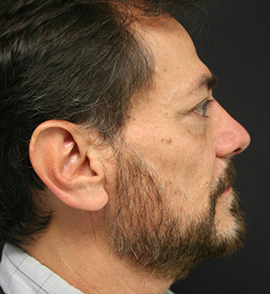 Nose Surgery (Rhinoplasty)