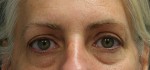 Eyelid Surgery (Blepharoplasty)