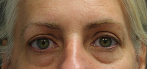 Eyelid Surgery (Blepharoplasty)