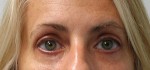 Eyelid Surgery (Blepharoplasty)