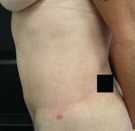 Liposuction
