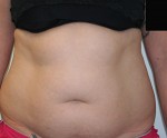 Liposuction