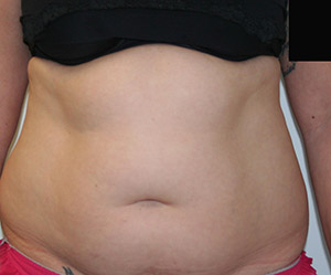Liposuction