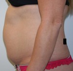 Liposuction