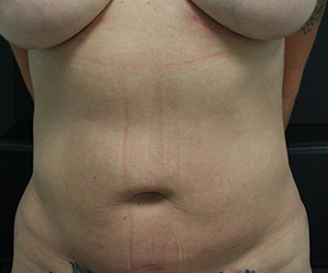 Liposuction