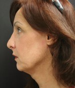 Face Lift
