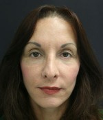 Face Lift