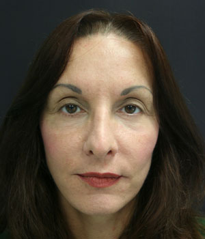 Face Lift