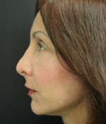 Face Lift