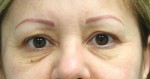 Eyelid Surgery (Blepharoplasty)