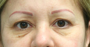 Eyelid Surgery (Blepharoplasty)