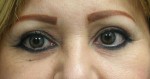 Eyelid Surgery (Blepharoplasty)