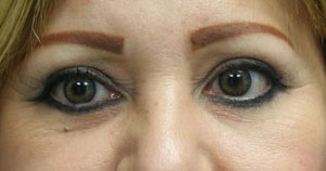 Eyelid Surgery (Blepharoplasty)