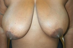 Breast Lift (Mastopexy)