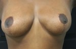 Breast Lift (Mastopexy)