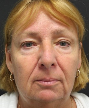 Face Lift