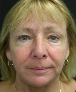 Face Lift