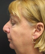Face Lift