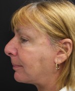 Face Lift
