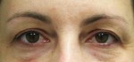 Eyelid Surgery (Blepharoplasty)