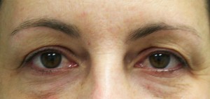 Eyelid Surgery (Blepharoplasty)