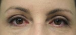 Eyelid Surgery (Blepharoplasty)