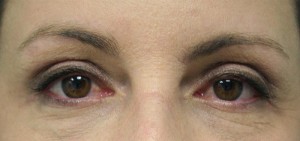 Eyelid Surgery (Blepharoplasty)