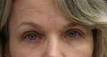 Eyelid Surgery (Blepharoplasty)