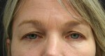 Eyelid Surgery (Blepharoplasty)