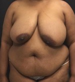Tummy Tuck (Abdominoplasty)