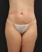 Tummy Tuck (Abdominoplasty)