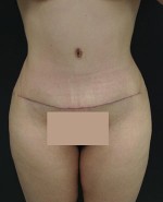 Tummy Tuck (Abdominoplasty)