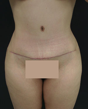 Tummy Tuck (Abdominoplasty)