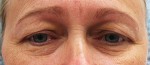 Eyelid Surgery (Blepharoplasty)