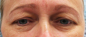 Eyelid Surgery (Blepharoplasty)